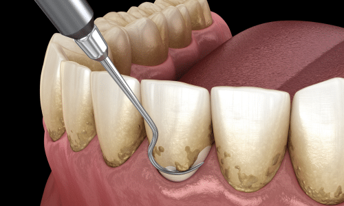 diferencia entre gingivitis y periodontitis