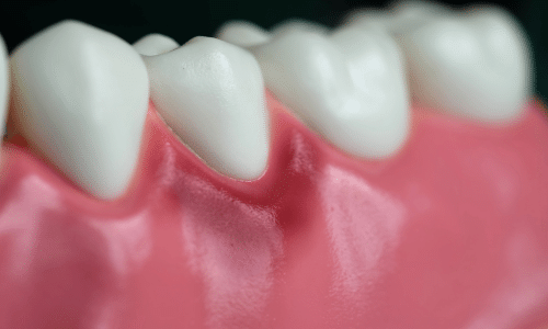 gingivitis y periodontitis