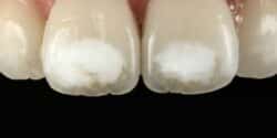 hipoplasia-dental tratamiento