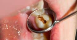 tratamiento caries barakaldo