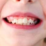 corregir maloclusion dental barakaldo