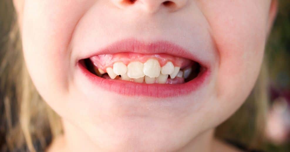 corregir maloclusion dental barakaldo
