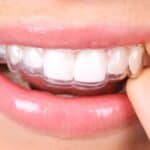 retenedor dental en barakaldo