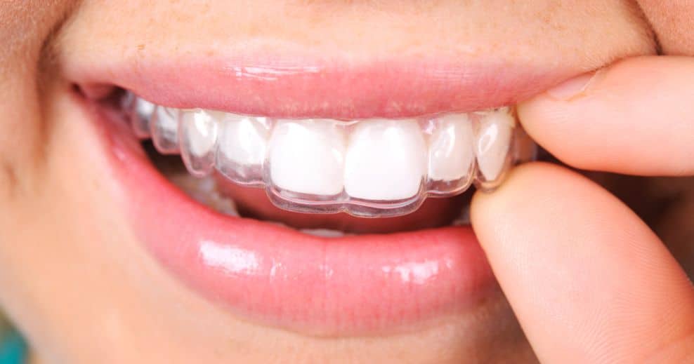 retenedor dental en barakaldo