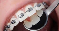 brackets en barakaldo