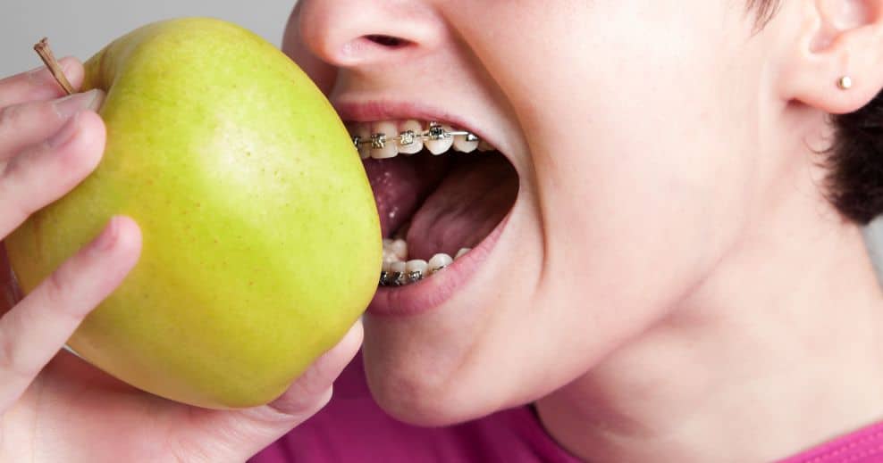 que comer con brackets