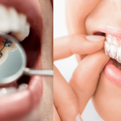 Ortodoncia lingual o invisalign