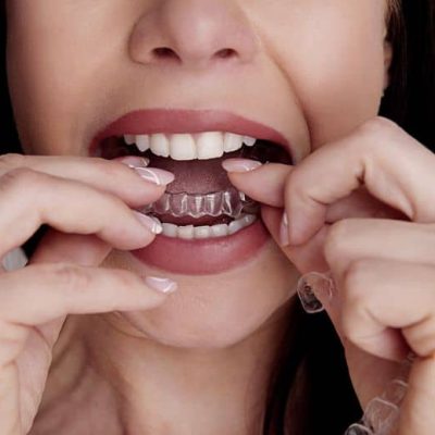 tratamiento invisalign barakaldo